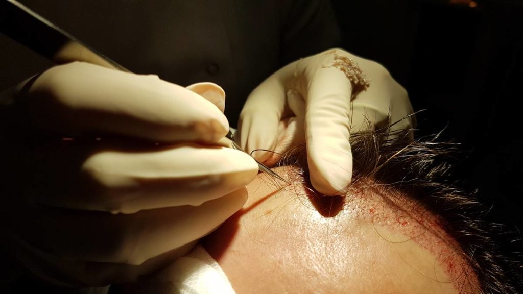 hair transplant paris