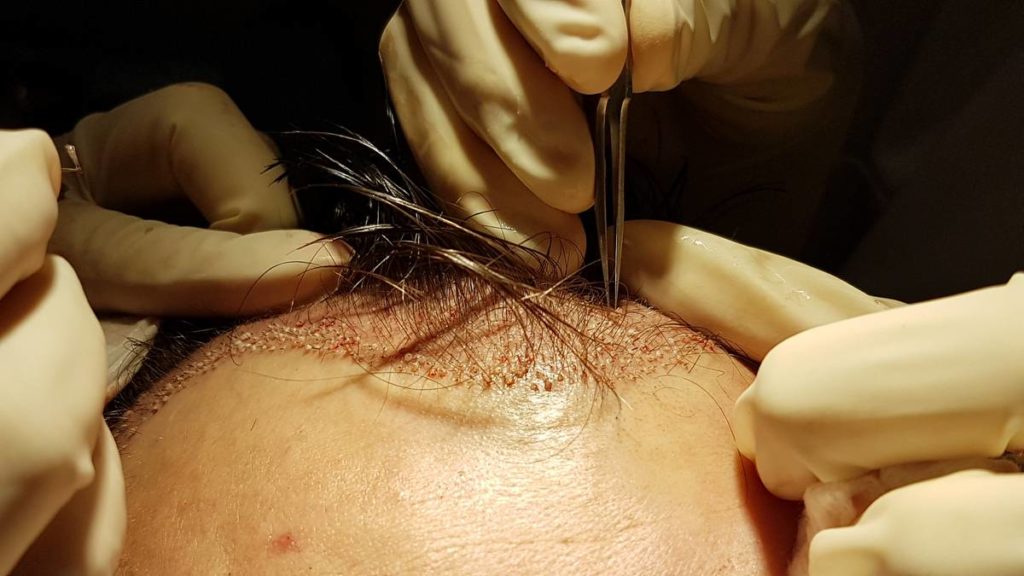 hair transplant paris