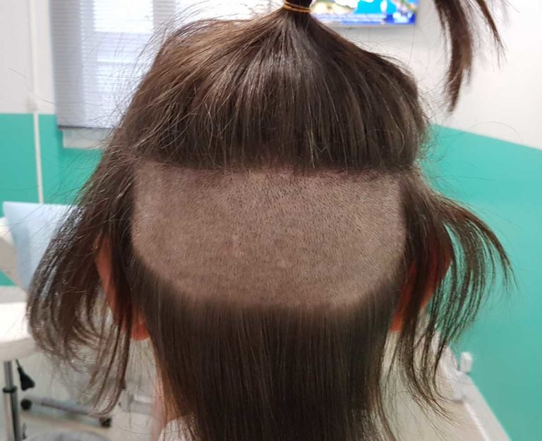 greffe de cheveux val d'oise