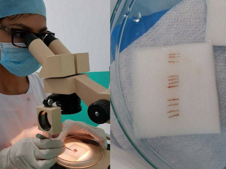 Hair transplant paris